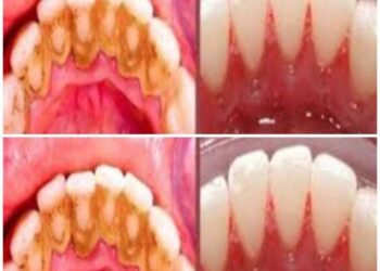 Zahnbelag selbst entfernen: Schnelles und einfaches Hausmittel