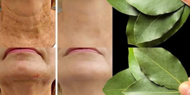 Ist Lorbeerblatt 100.000 Mal wirksamer als Botox? | Natürlicher Faltenentferner, auch mit 70