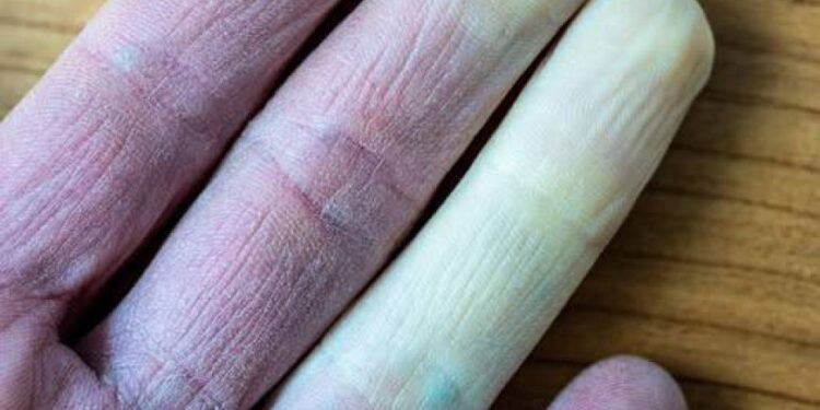 Warum ändern die Finger ihre Farbe