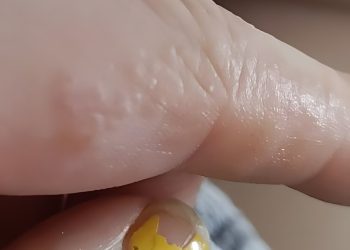 Das sind diese kleinen juckenden Beulen an deinen Fingern