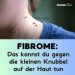 Fibrome: Das kannst du gegen die kleinen Knubbel auf der Haut tun