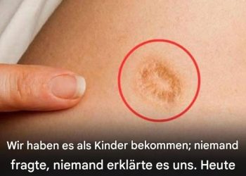 5 häufige Irrtümer über die runde Narbe am Oberarm