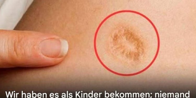 5 häufige Irrtümer über die runde Narbe am Oberarm