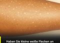 Weiße Flecken auf der Haut: Welche Vitaminmängel könnten die Ursache sein