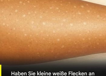 Weiße Flecken auf der Haut: Welche Vitaminmängel könnten die Ursache sein