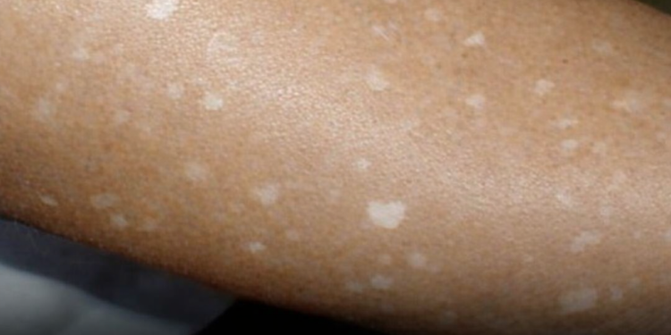 Weiße Flecken auf der Haut: Welche Vitaminmängel könnten die Ursache sein?
