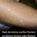 Weiße Flecken auf der Haut: Welche Vitaminmängel könnten die Ursache sein?