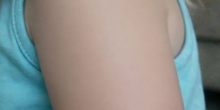 Viele Eltern erschrecken bei solchen Hautveränderungen – Das ist wichtig zu wissen